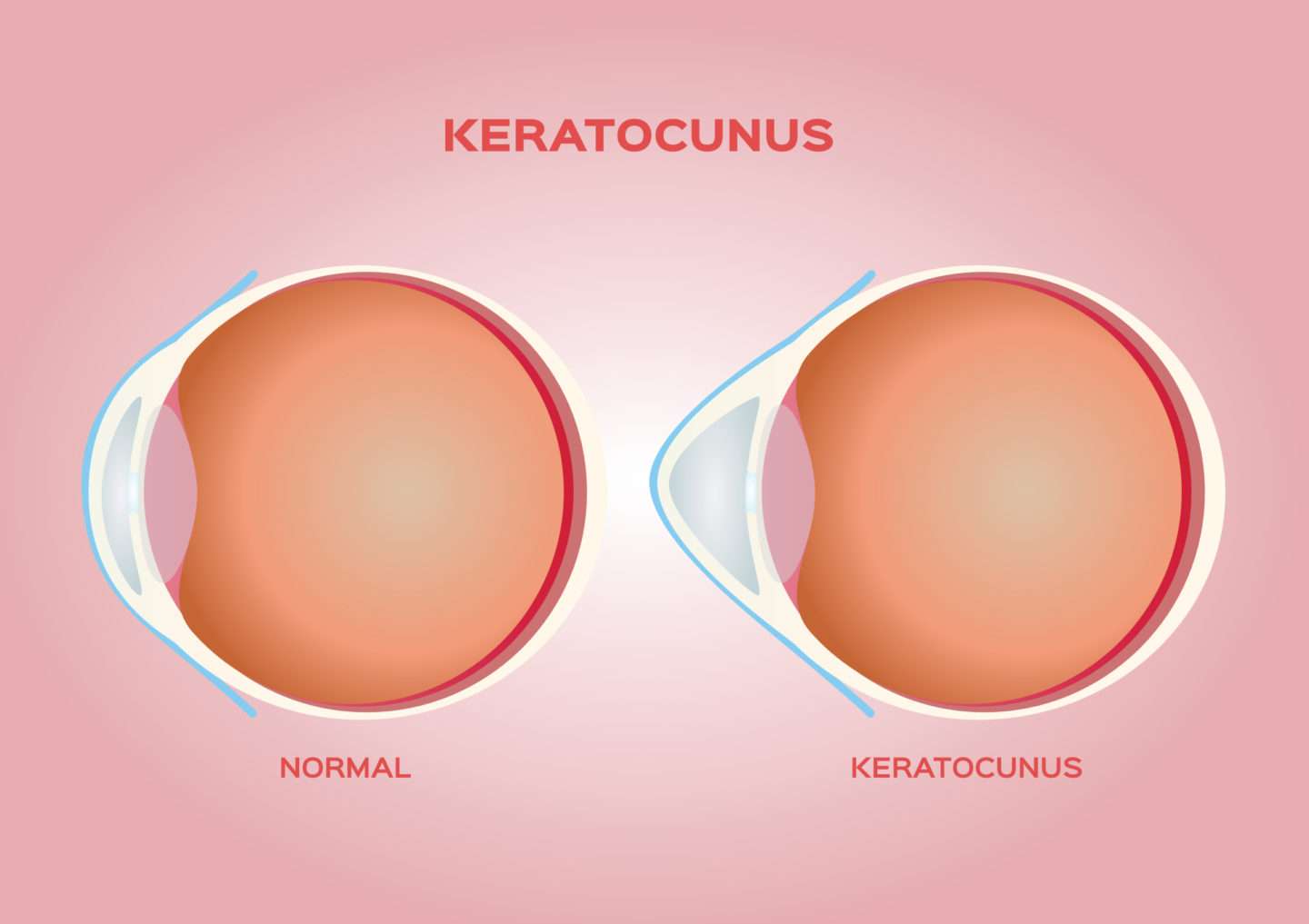 keratocunus