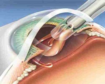 Advanced Cataract Surgeries in Aurangabad at Shri Krishna Netralaya