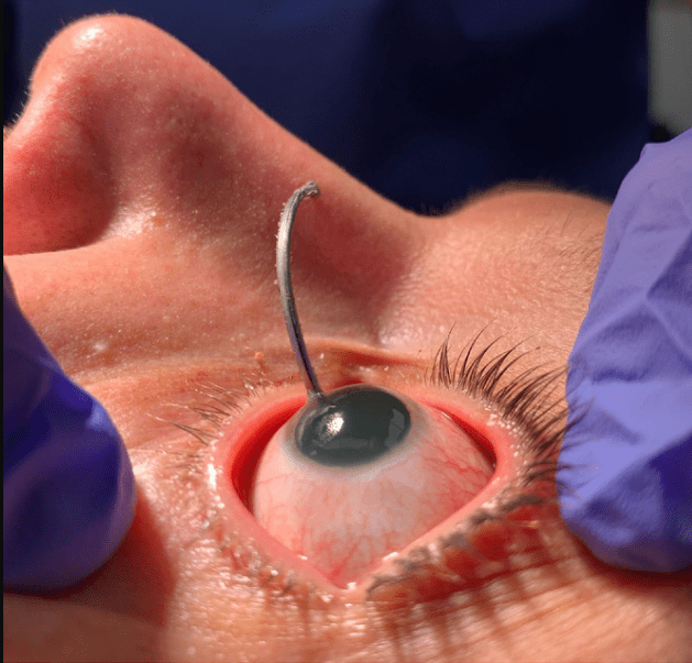 Advanced Cataract Surgeries in Aurangabad at Shri Krishna Netralaya Clinic