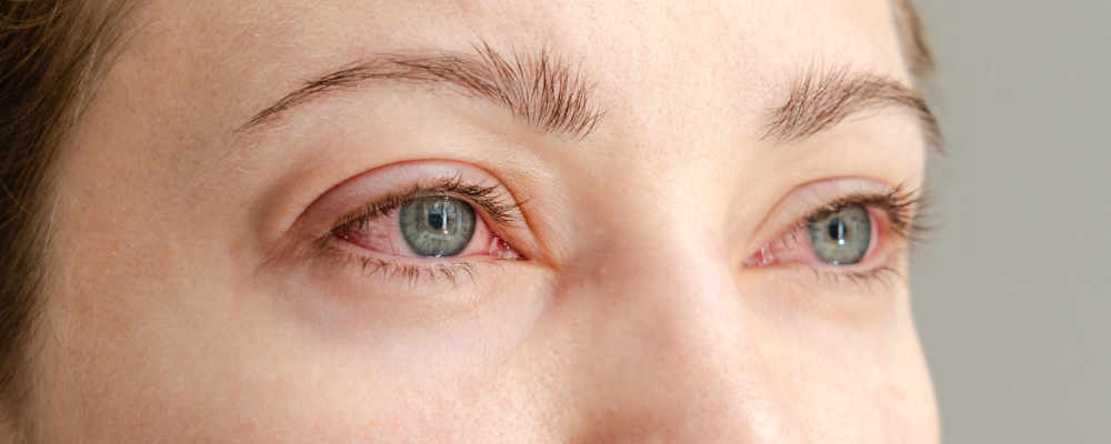 Dry Eyes: Why They Keep Coming Back